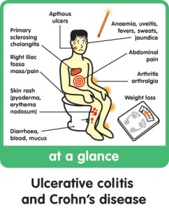 colitis